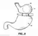 Fig. 05 - Methods and devices for maintaining a space occupying device in a relatively fixed location within a stomach