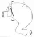 Fig. 06 - Methods and devices for maintaining a space occupying device in a relatively fixed location within a stomach