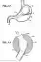 Fig. 08 - Methods and devices for maintaining a space occupying device in a relatively fixed location within a stomach