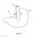 Fig. 22 - Obesity treatment tools and methods