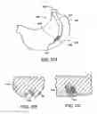 Fig. 26 - Obesity treatment tools and methods