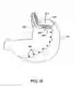 Fig. 29 - Obesity treatment tools and methods