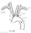 Fig. 08 - Removable blood conduit filter