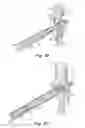 Fig. 10 - Catch members for occluder devices