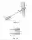 Fig. 12 - Catch members for occluder devices