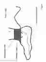 Fig. 02 - Method and apparatus for low frequency induction therapy for the treatment of urinary incontinence and overactive bladder
