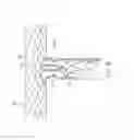 Fig. 16 - Bifurcated stent and delivery system