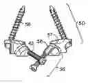 Fig. 01 - Prostheses, tools and methods for replacement of natural facet joints with artificial facet joint surfaces