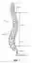 Fig. 02 - Prostheses, tools and methods for replacement of natural facet joints with artificial facet joint surfaces