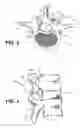 Fig. 03 - Prostheses, tools and methods for replacement of natural facet joints with artificial facet joint surfaces