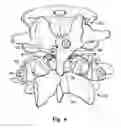 Fig. 04 - Prostheses, tools and methods for replacement of natural facet joints with artificial facet joint surfaces