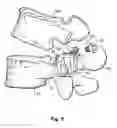 Fig. 05 - Prostheses, tools and methods for replacement of natural facet joints with artificial facet joint surfaces