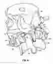 Fig. 06 - Prostheses, tools and methods for replacement of natural facet joints with artificial facet joint surfaces