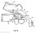 Fig. 14 - Prostheses, tools and methods for replacement of natural facet joints with artificial facet joint surfaces