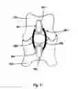 Fig. 11 - Prosthetic facet and facet joint replacement device