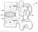 Fig. 01 - Materials, devices and methods for treating multiple spinal regions including vertebral body and endplate regions