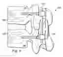 Fig. 06 - Materials, devices and methods for treating multiple spinal regions including vertebral body and endplate regions