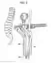 Fig. 06 - Motion disc spike seating instrument