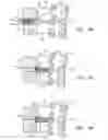 Fig. 06 - Percutaneous cervical disc reconstruction