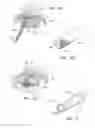 Fig. 09 - Percutaneous cervical disc reconstruction