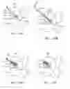 Fig. 16 - Percutaneous cervical disc reconstruction