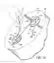 Fig. 13 - Method and apparatus for preventing leakage of bodily fluids and other fluids during embalming to preserve the dignity of the deceased during memorial services