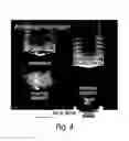 Fig. 04 - Process for aseptic vacuum filling and stoppering of low viscosity liquids in syringes