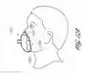 Fig. 27 - Volume-adjustable manual ventilation device