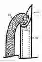 Fig. 01 - U-shaped disc shunt and delivery device