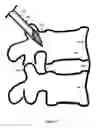 Fig. 09 - U-shaped disc shunt and delivery device