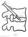 Fig. 13 - U-shaped disc shunt and delivery device
