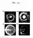 Fig. 08 - Device for controlling particle distribution in an evaporating droplet using radial electroosmotic flow