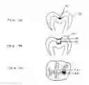 Fig. 05 - Antimicrobial dental materials, restorations, and prostheses