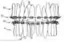 Fig. 01 - HYBRID ORTHODONTIC ARCHWIRE