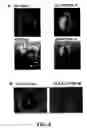 Fig. 07 - Methods and compositions for diagnosing and suppressing metastasis thereof