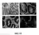 Fig. 14 - Methods and compositions for diagnosing and suppressing metastasis thereof