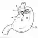 Fig. 01 - Method of implating a medical device using a suture tab extender
