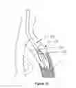 Fig. 08 - Methods for enhancing fluid flow through an obstructed vascular site, and systems and kits for use in practicing the same