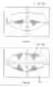 Fig. 24 - System and method for treating the structure of the human lens with a laser