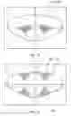 Fig. 28 - System and apparatus for treating the lens of an eye