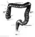 Fig. 02 - Minimally invasive methods for thermal treatment