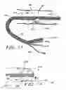 Fig. 06 - Minimally invasive methods for thermal treatment