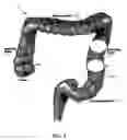 Fig. 07 - Minimally invasive methods for thermal treatment