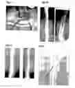 Fig. 06 - Method, members, system and program for bone correction