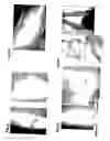Fig. 09 - Method, members, system and program for bone correction
