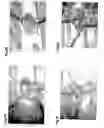 Fig. 22 - Method, members, system and program for bone correction