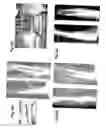 Fig. 32 - Method, members, system and program for bone correction