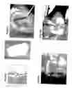 Fig. 35 - Method, members, system and program for bone correction