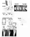 Fig. 43 - Method, members, system and program for bone correction