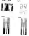Fig. 44 - Method, members, system and program for bone correction